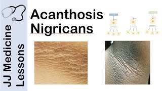 gyomorrák acanthosis nigricans