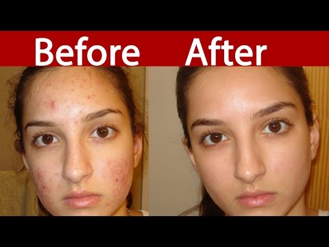 चेहरे के दाग धब्बे हटाये |acne removal |acne scars |clear skin |pigmentation on face |dark spots