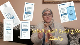 ماهو افضل علاج لقشرة الشعر الحادة الذهنية والجافة والحكة والالتهابات نهائيا