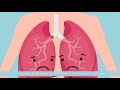 Vídeo 1 - ¿Qué es la Fibrosis Quística?