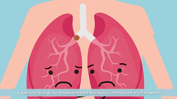 ¿Qué ocurre si no se trata la fibrosis quística?