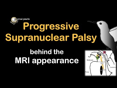 Progressive supranuclear palsy - understanding the signs on MRI