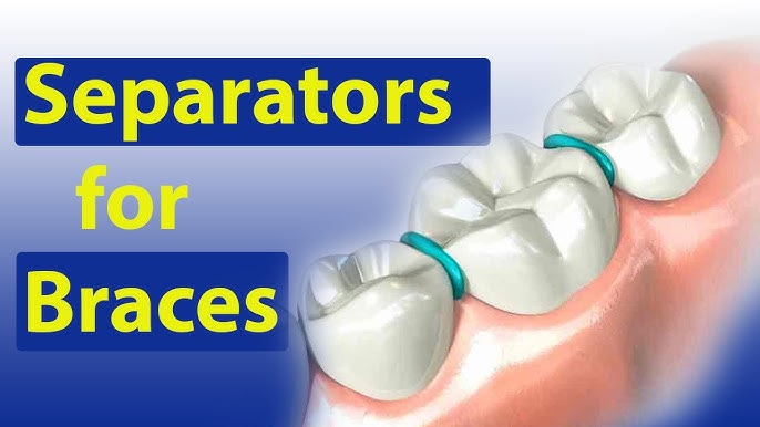 How do elastic rubber bands for braces work? – Somos Dental