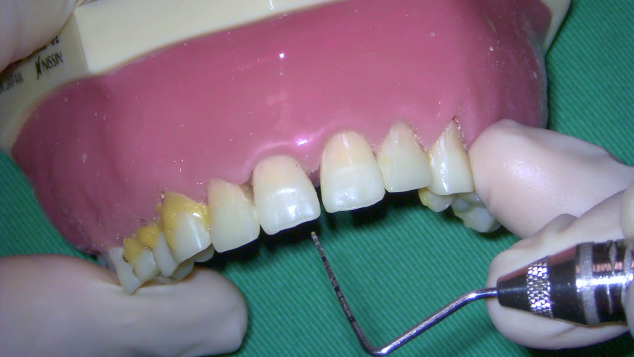 Periodontal Examination Series 9 Periodontal Pocket Depth Periodontal Examination Series 9 Periodontal Pocket Depth