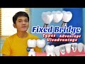 FIXED BRIDGE For Spaces And Gaps Masama Ba FIXED BRIDGE For Spaces And Gaps Masama Ba