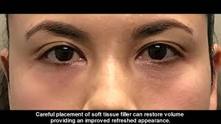 Infraorbital Undereye Aging Treated with Soft Tissue Filler Cannula Technique-Dr. Howard Liu screenshot 1