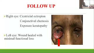 Aiocmtc4 2025 Fp19 Dr Easther Daziine Periorbital Necrotising Fasciitis Masquerading Chronic