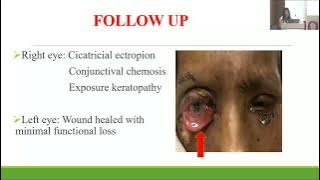 AIOCMTC4 2025   FP19 Dr Easther Daziine   PERIORBITAL NECROTISING FASCIITIS MASQUERADING CHRONIC