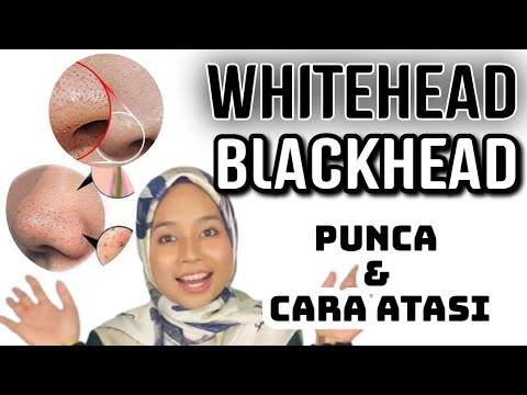 Video: Cara Menghilangkan Blackhead Dengan Cepat: Petua Rawatan Dan Pencegahan Untuk Lelaki