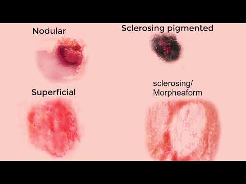 Basal Cell Carcinoma