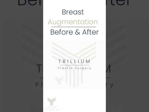 Breast Augmentation: Before & After