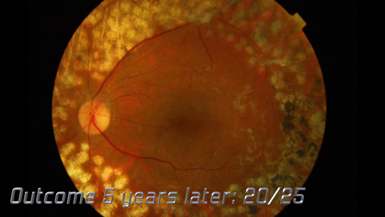 proliferative diabetic retinopathy