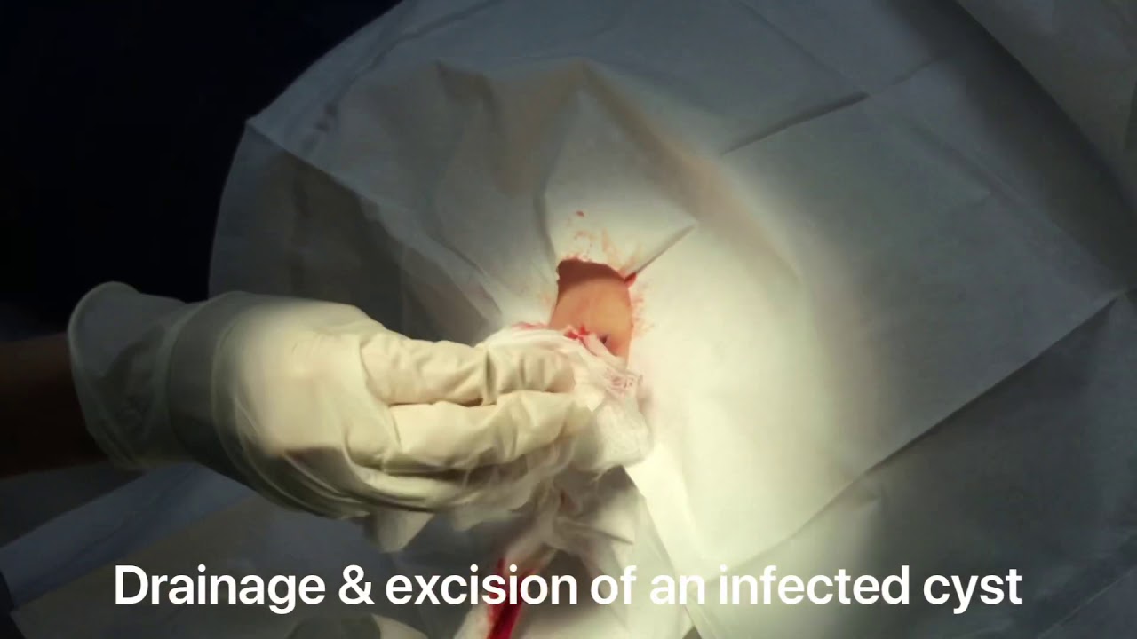 Drainage and removal of an infected cyst on the back 