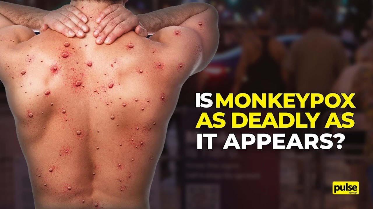 Is Monkeypox as deadly as it appears?