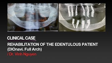 Full-mouth rehabilitation of an edentulous patient with DIOnavi. FullArch