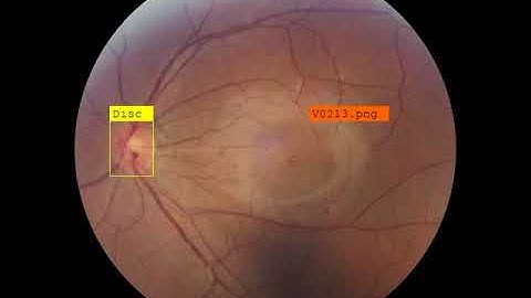 Optic Disc Detection from fundus image