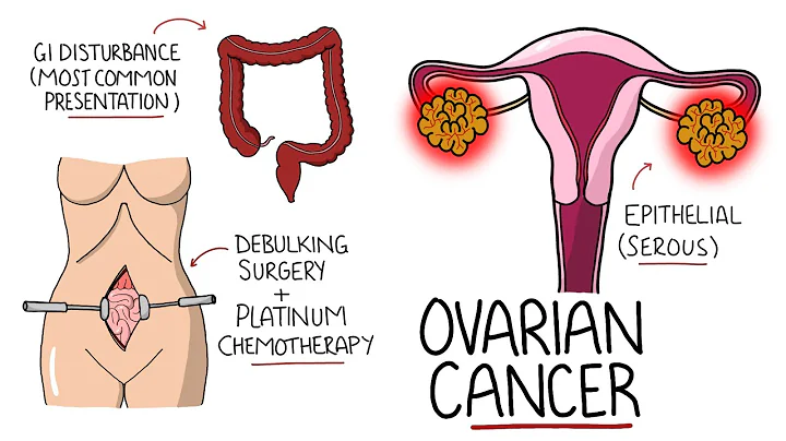 Ovarian Cancer Explained (Including Subtypes) - DayDayNews