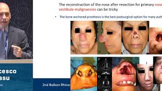 Interstitial brachytherapy for the management of nose vestibule
malignancy francesco bussu, sassari, italy