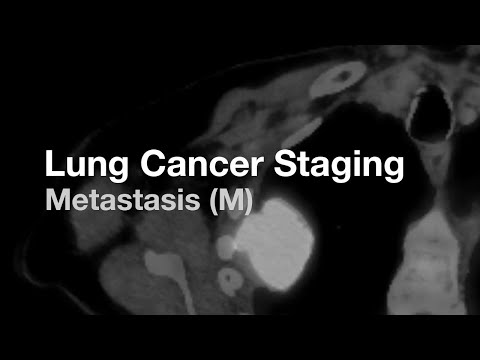 Video: Vai holangiokarcinoma izplatās plaušās?