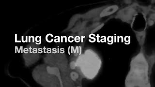 Lung Cancer Staging  Metastasis (M)