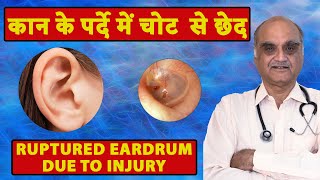 Ruptured eardrum due to injury। कान के परदे में चोट से छेद । Hindi। Dr. Rajive Bhatia