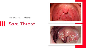 Sore Throat: Viral or Bacterial Infection