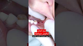 زرع الاسنان وتلبيس سيراميك