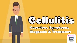 Cellulitis - Overview, Symptoms, Diagnosis & Treatment