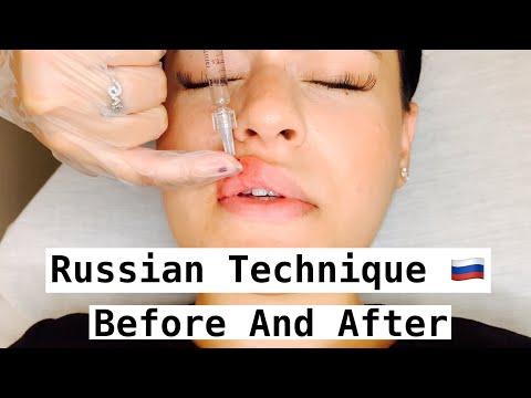 Russian Lip Technique - with Before and After