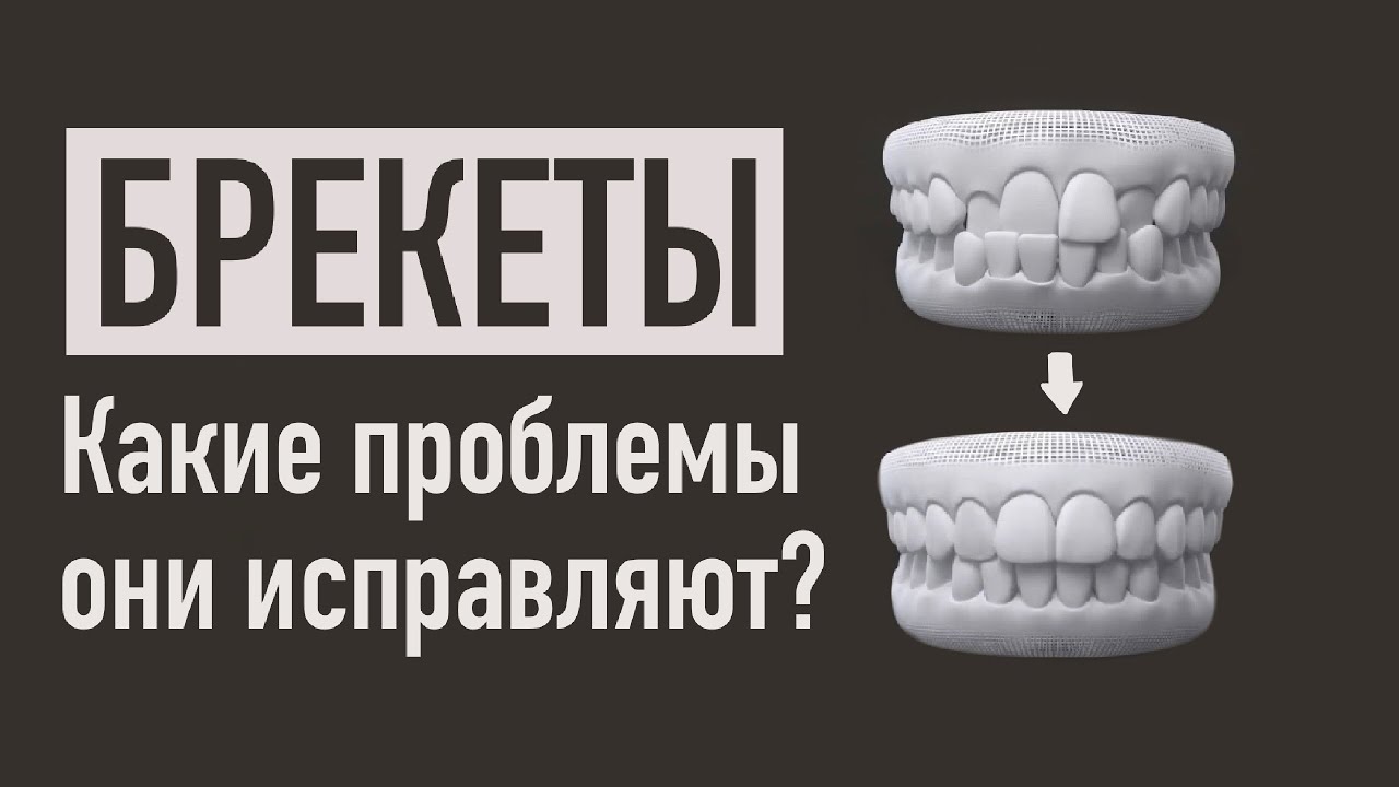 ЧТО ИСПРАВЛЯЮТ БРЕКЕТЫ? РАСПРОСТРАНЕННЫЕ ОРТОДОНТИЧЕСКИЕ ПРОБЛЕМЫ - YouTube