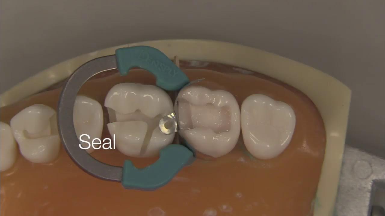 Class II Composite Restoration Stevenson Dental Solutions YouTube