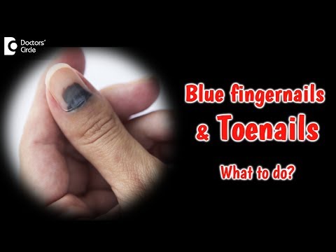 Bluish discoloration of nails. What does it mean?  Dr. Rajdeep Mysore