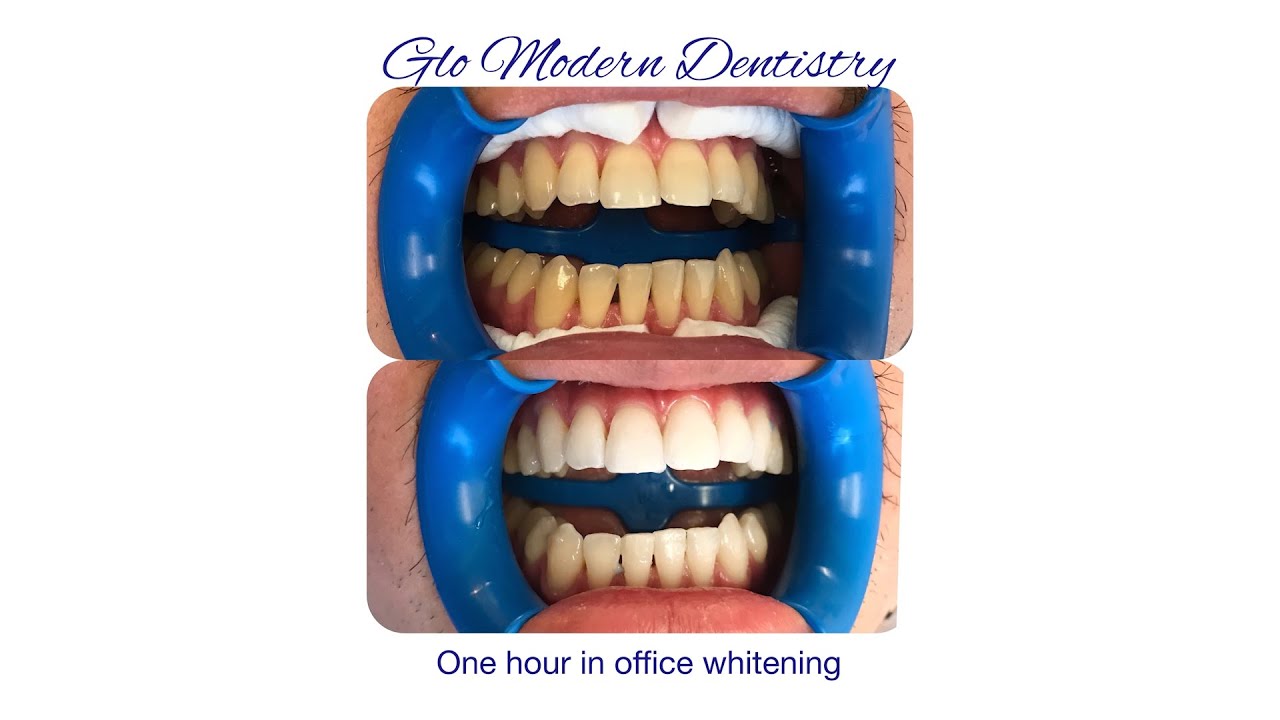 Teeth Whitening in Hollywood