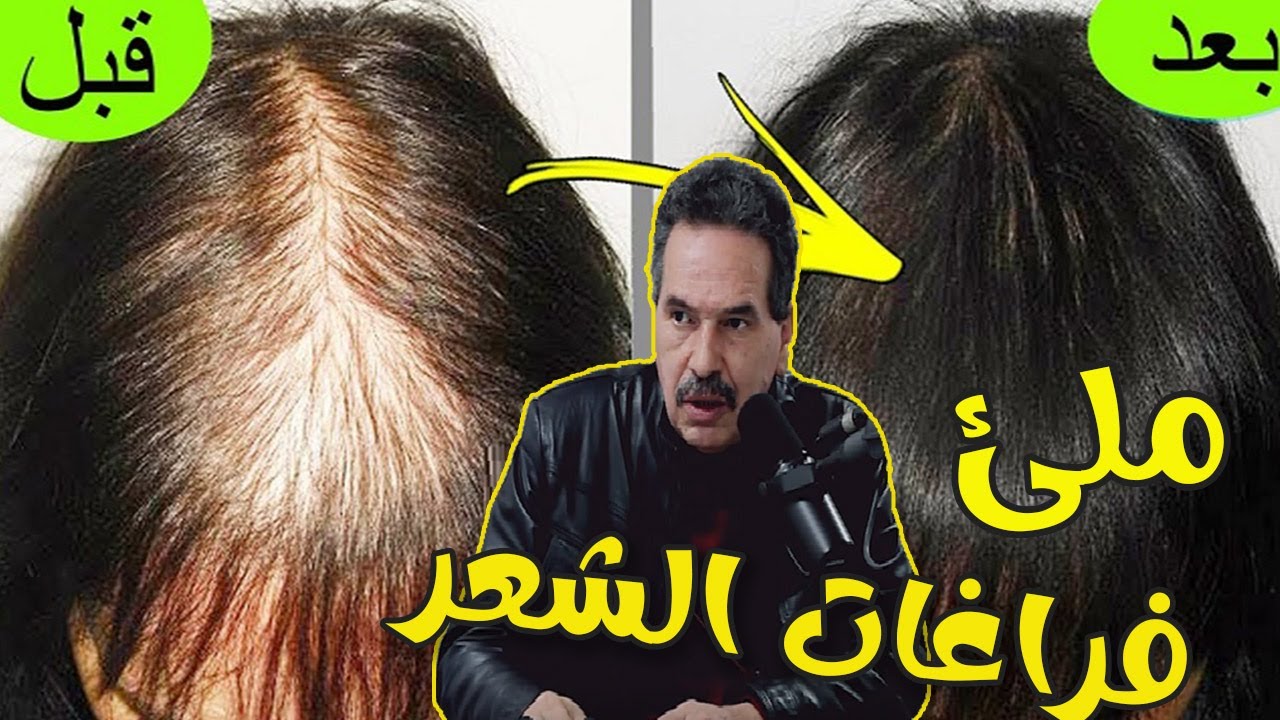 مكونات طبيعية لإنباث فراغات الشعر  مع الدكتور جمال الصقلي