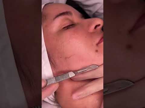 Dermaplaning