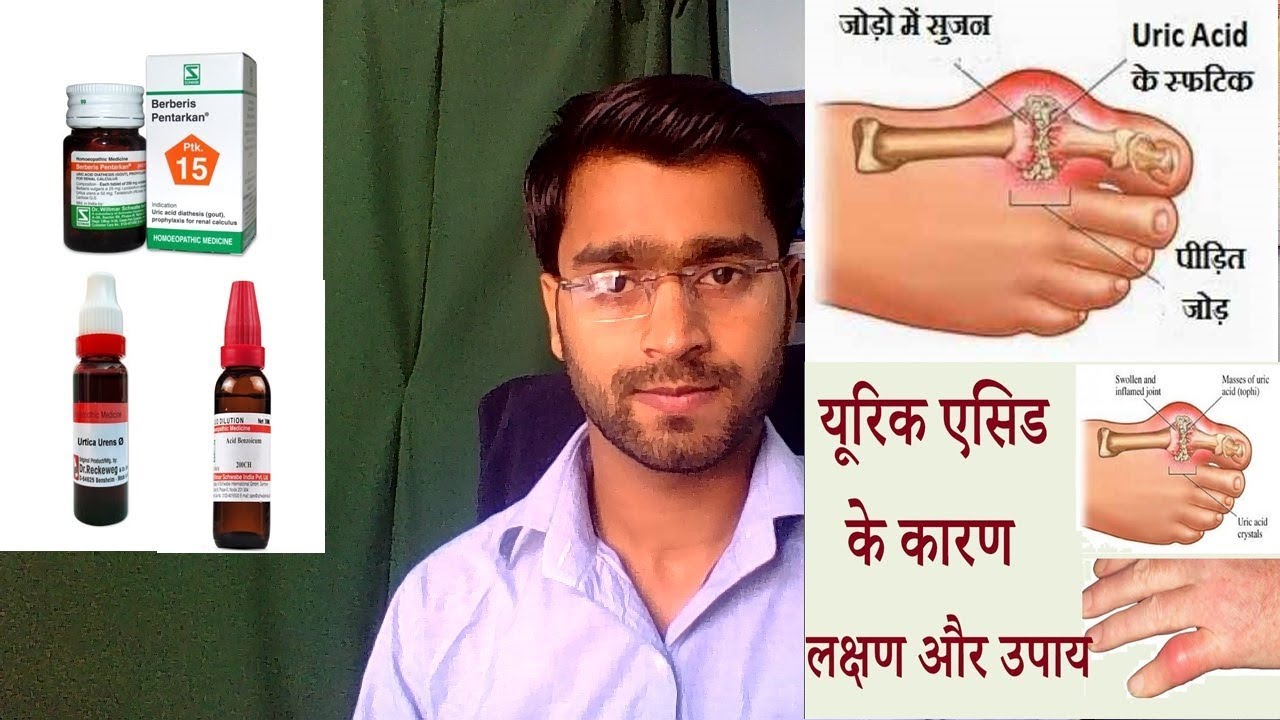 Gout Increased Uric Acid And Homeopathic Medicine Youtube