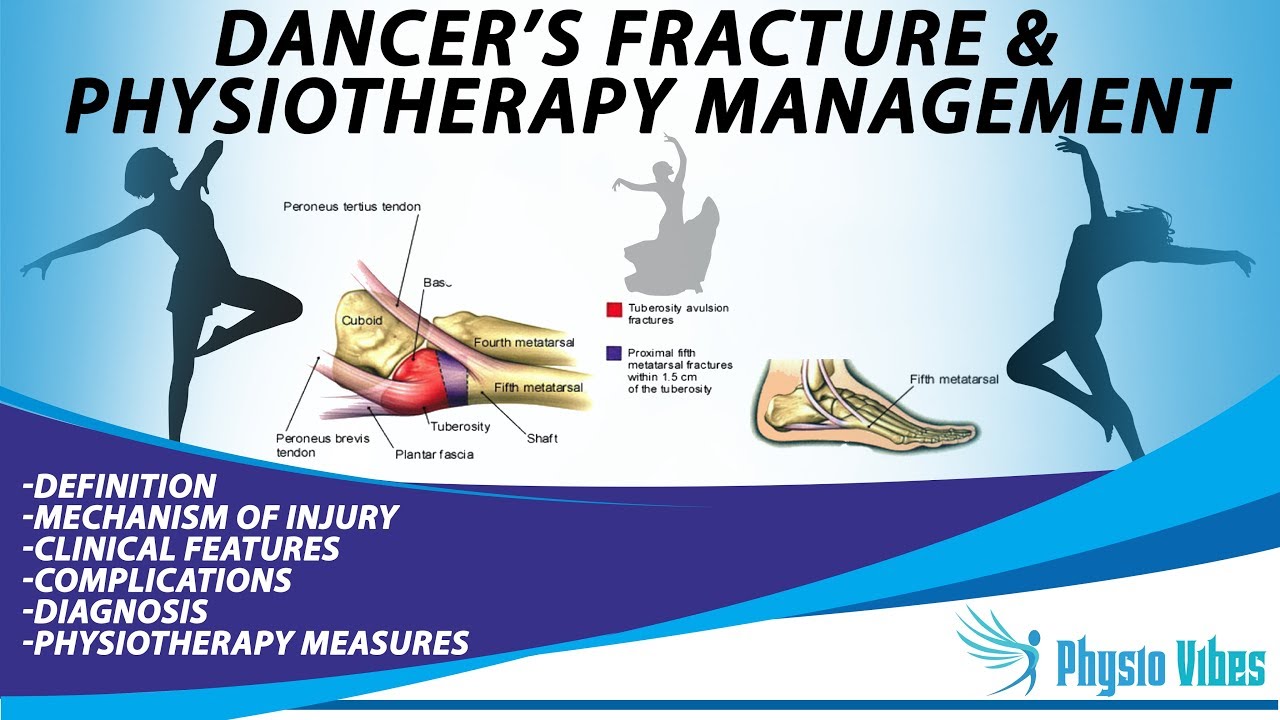 DANCER'S FRACTURE & PHYSIOTHERAPY MANAGEMENT YouTube