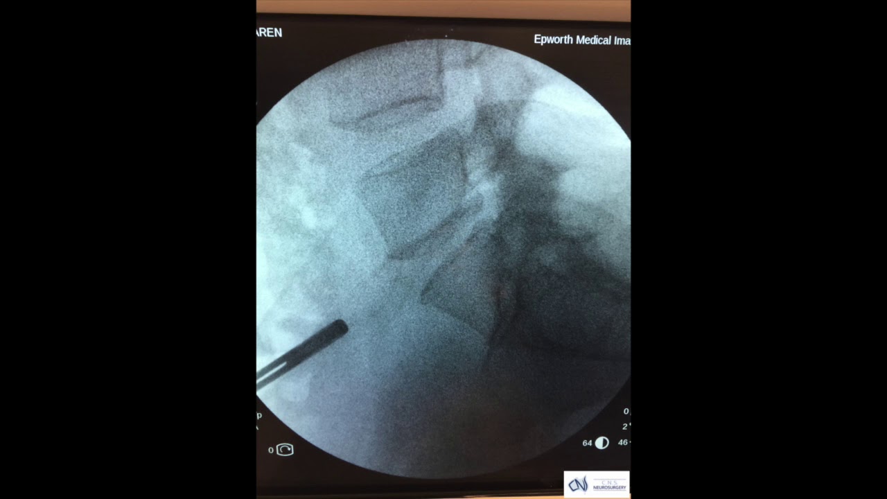 Lumbar Disc Arthroplasty YouTube