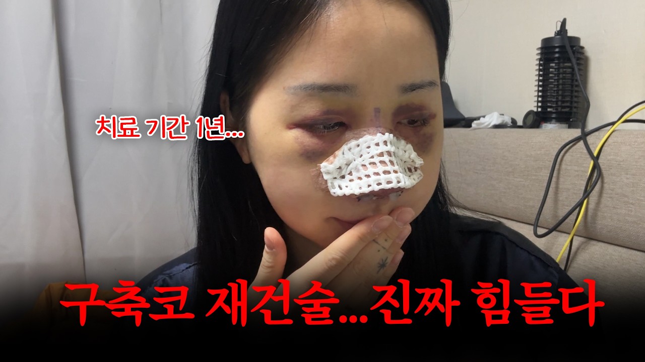 N번째 구축코 코재수술… 이번이 진짜 마지막일까요? (들린코, 들창코 교정)😭 [화린3Vlog]