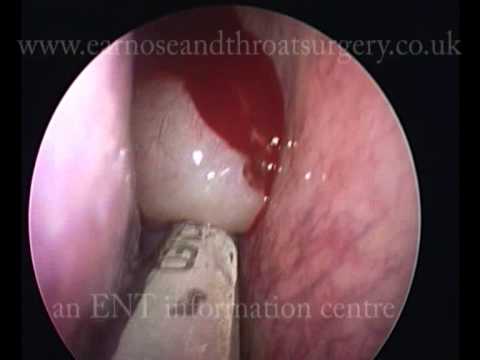 What Operasi Sinusitis