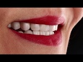 Hollywood smile makeover with emax cad crowns and veneers by bay dental associates