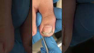 Dirty toenails, clean！pedicure ingrown_toenail