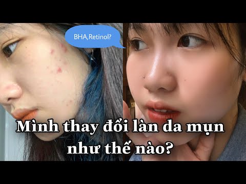 MÌNH ĐÃ THAY ĐỔI LÀN DA MỤN NHƯ THẾ NÀO? mình dùng BHA,Retinol như thế nào? Minh Ngọc