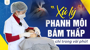 Xóa Bỏ Phanh Môi Bám Thấp Chỉ Trong Vài Phút - Bạn Có Tin Không | Bác sĩ Trung Long Biên