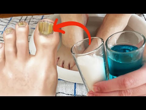 Video: 3 načina da popravite rascjepljeni nokat na nozi