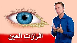 عُماص العين | السبب والحل لمشاكل الحكة و افرازات العين