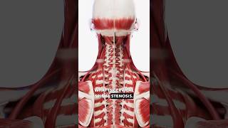 What is cervical spinal stenosis spinalstenosis cervicaldischerniation neckpainrelief neckpain