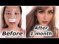 Rhinoplasty 1 month update BEFORE & AFTER | ID Hospital Surgery PART 2