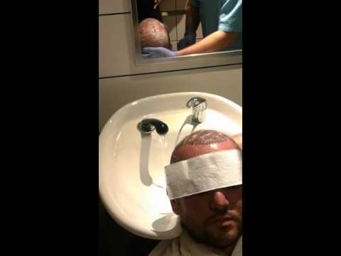 Hair wash after Hair Transplantation Operation - غسل الشعر بعد عملية زراعة الشعر