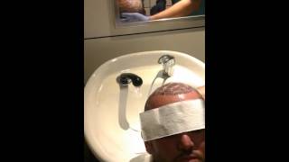 Hair wash after Hair Transplantation Operation - غسل الشعر بعد عملية زراعة الشعر